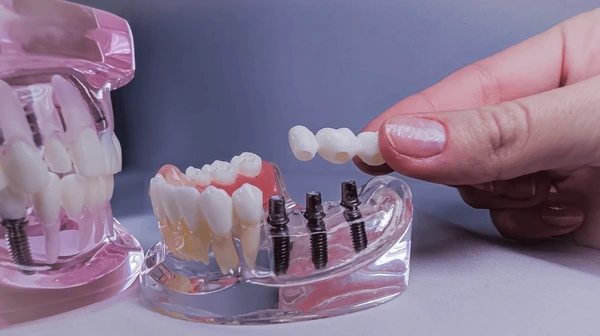 dental bridges near you