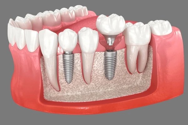 dental implants in midtown toronto on