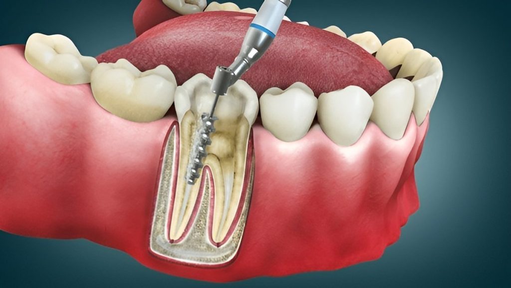 root canal treatment near you