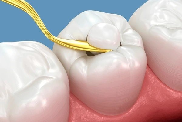 tooth coloured fillings near you